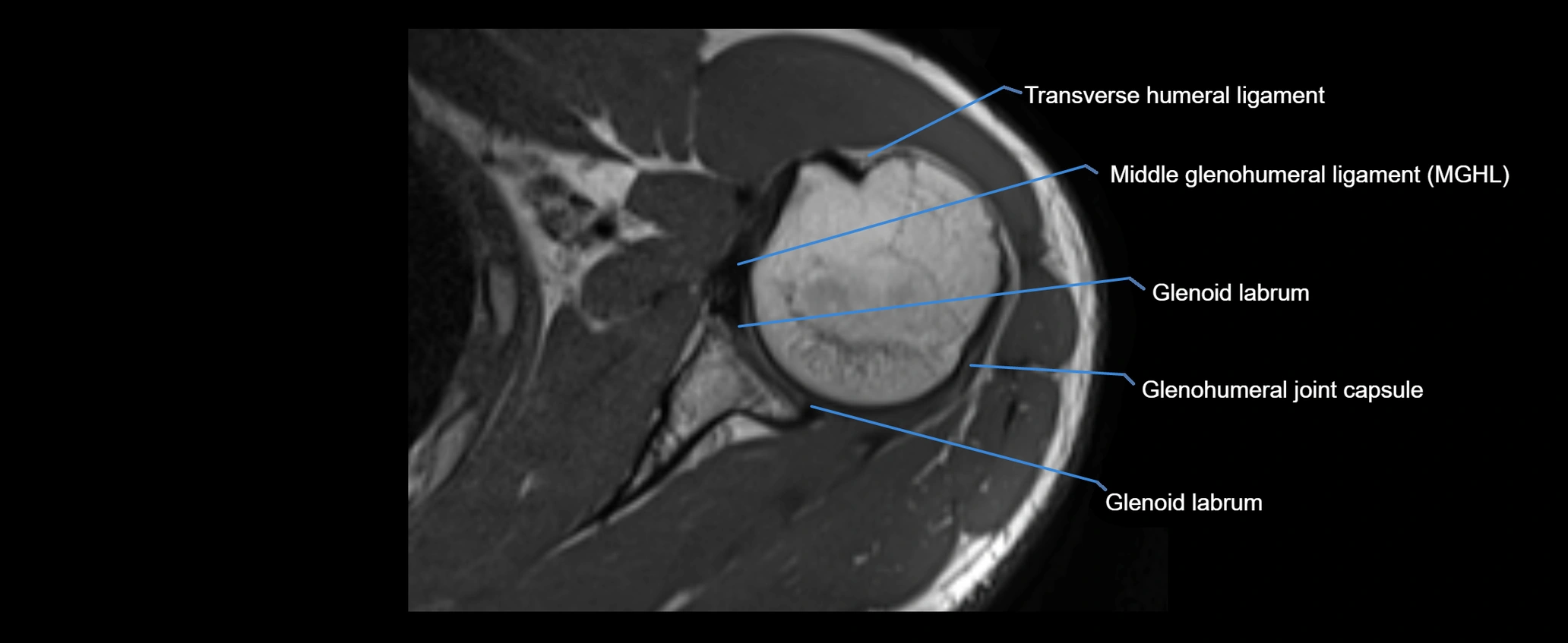 shoulder ligaments axial 3d 3t mri image-img-00005-00065.webp